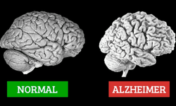 Alzheimer'ın İlk Belirtilerine Dikkat! Unutkanlık, Kişilik Değişimleri ve Daha Fazlası