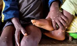 Nijerya’da Mpox Vakaları Artıyor! Toplam Vaka Sayısı 84’e Ulaştı