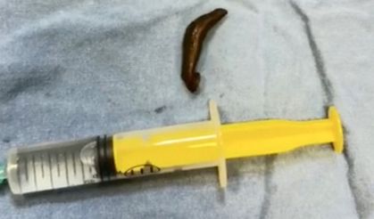 Hastanın boğazından çıktı, doktorlar şaştı kaldı