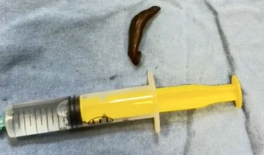 Hastanın boğazından çıktı, doktorlar şaştı kaldı