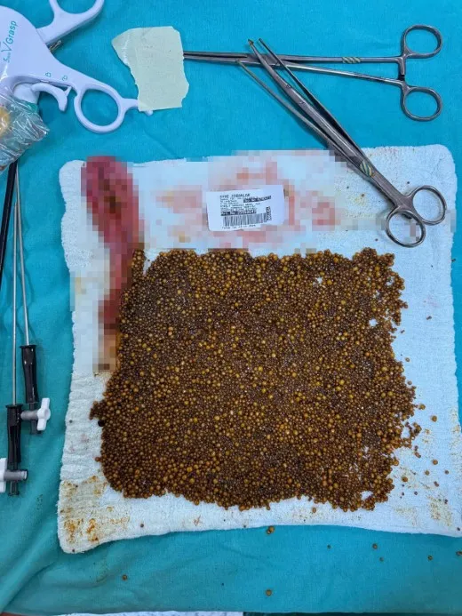 Karın Ağrısı Şikayetiyle Gitti, 20 Binin Üzerinde Taşla Hastaneden Çıktı